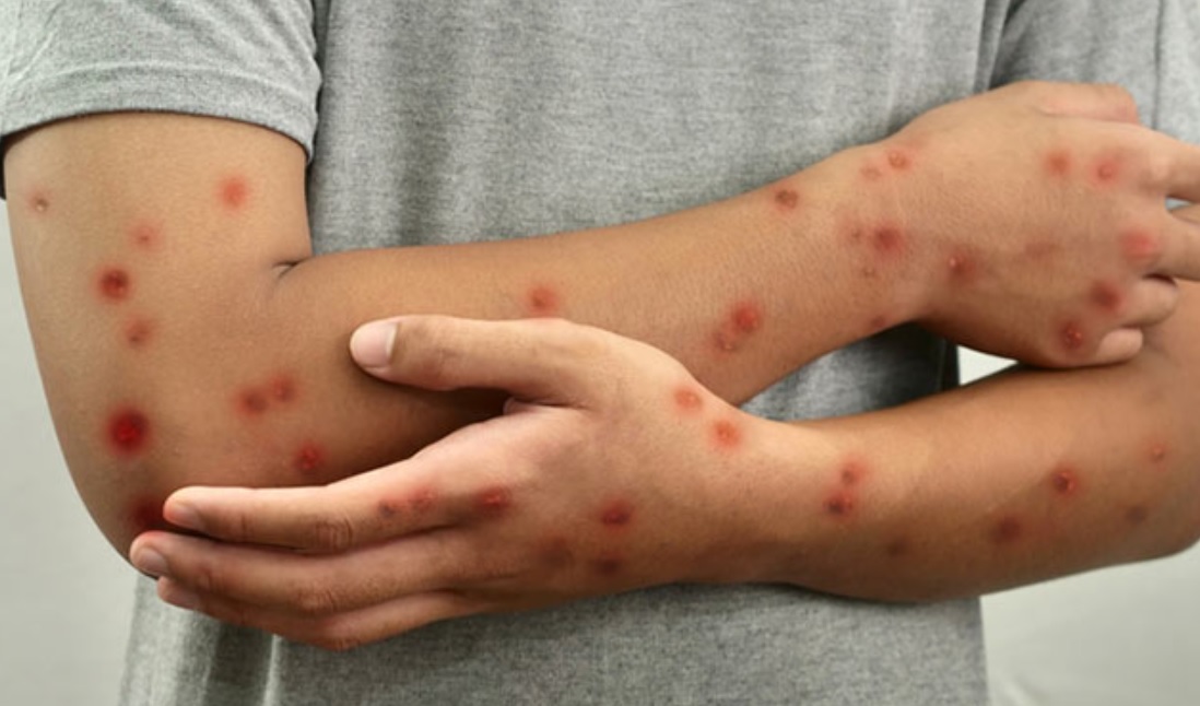 ПОТВРДЕНИ СЛУЧАИ НА МАЈМУНСКИ СИПАНИЦИ Граѓаните да бидат внимателни ПОТВРДЕНИ СЛУЧАИ НА МАЈМУНСКИ СИПАНИЦИ Граѓаните да бидат внимателни